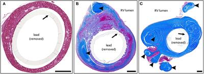 Quantitative and Qualitative Assessment of Adhesive Thrombo-Fibrotic Lead Encapsulations (TFLE) of Pacemaker and ICD Leads in Arrhythmia Patients—A Post Mortem Study